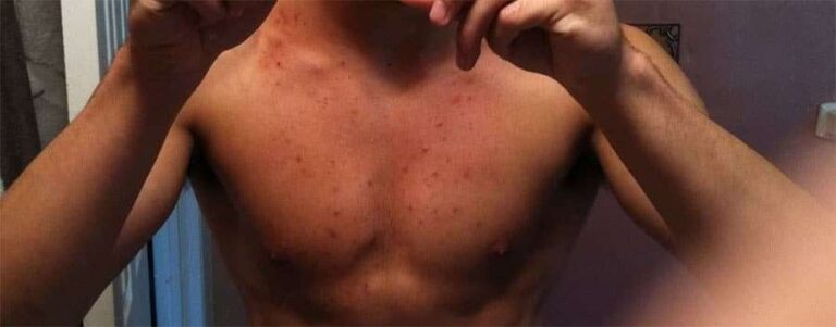 acne causada pela musculação