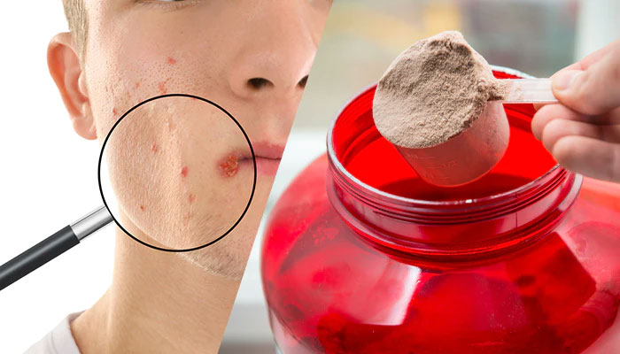 Tomar Whey Protein D Espinha causa Acne 